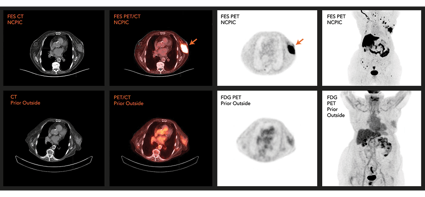 ER+ FES PET/CT