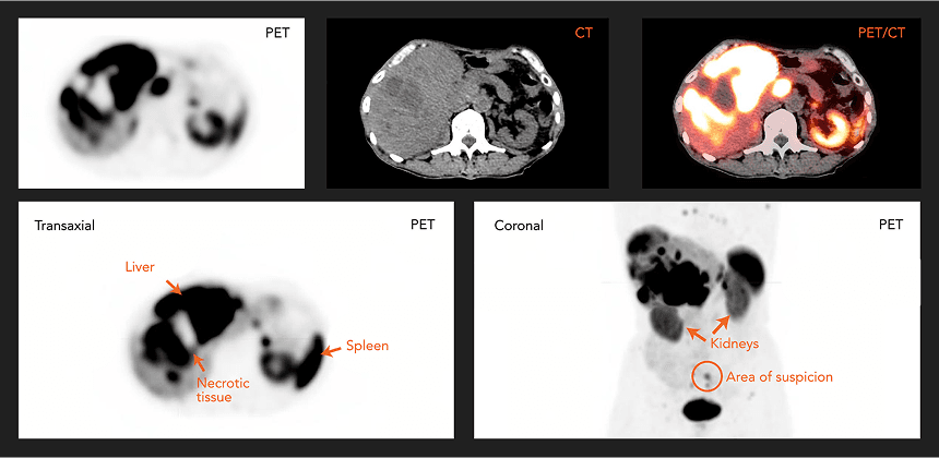 Dotatate PET/CT