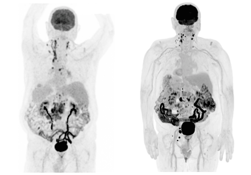 PET/CT For Subtle Findings