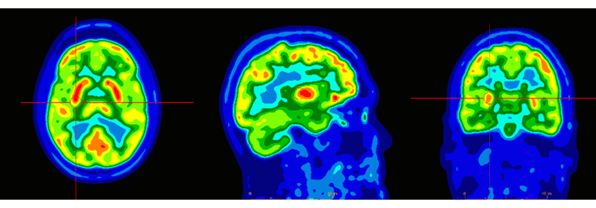 FDG PET Brain (Medicare Eligibility)