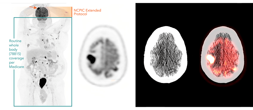 NCPIC's Extended FOV Protocol