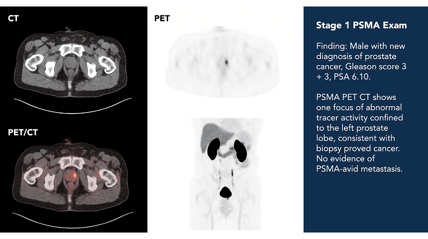 CT, PET, and PET/CT images of a Stage 1 PSMA exam: male with new diagnosis of prostate cancer, Gleason score 3+3, PSA 6.10. PSMA PET/CT shows one focus of abnormal tracer activity confined to the left prostate lobe, consistent with biopsy-proved cancer, with no evidence of PSMA-avid metastasis.