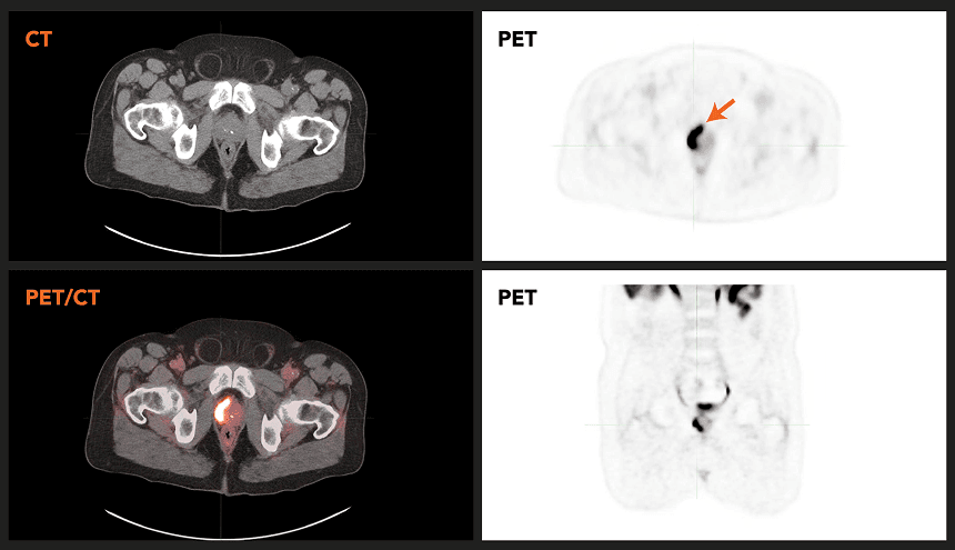 PSMA PET/CT Guide