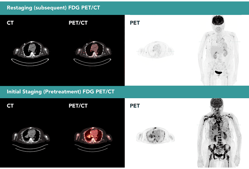 FDG PET/CT at Two Time Points