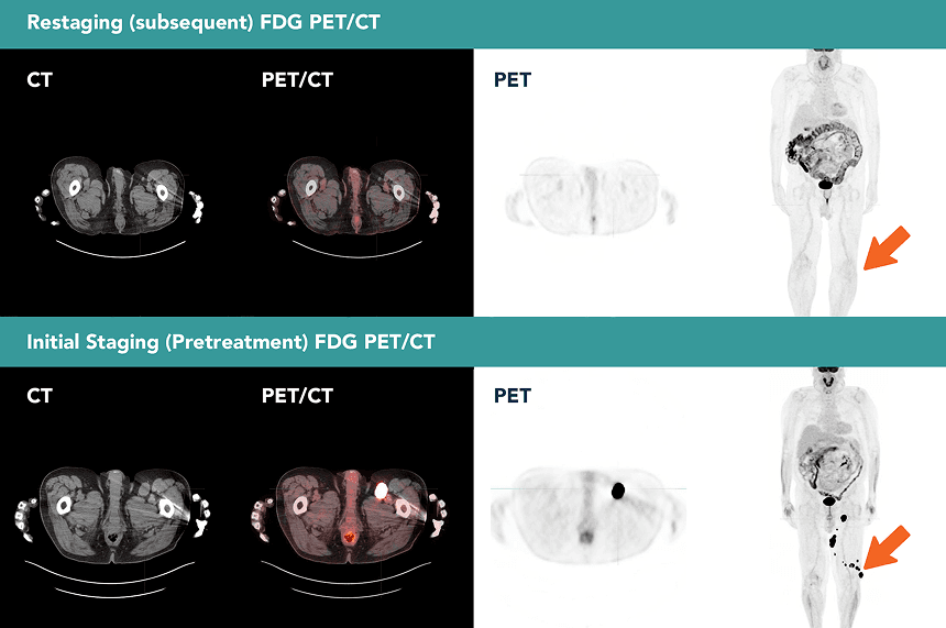 FDG PET/CT at Two Time Points
