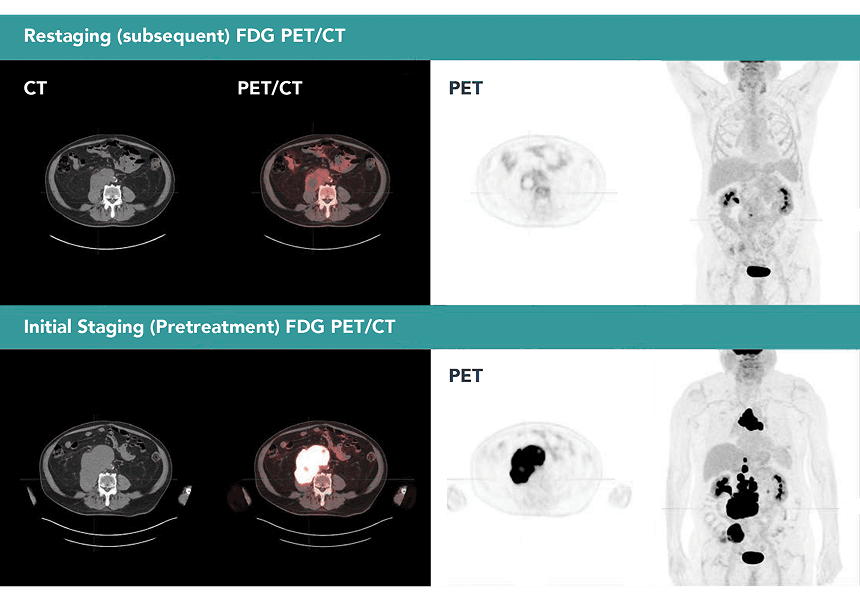 FDG PET/CT at Two Time Points