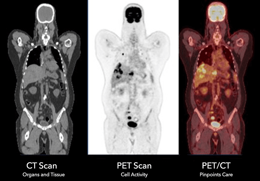 Side-by-side CT scan (organs and tissue), PET scan (cell activity), and combined PET/CT image (pinpoints care)