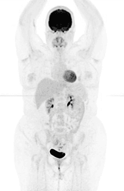 FDG PET scan covering skull base to mid-thigh
