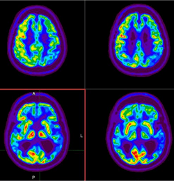 FDG PET brain scan