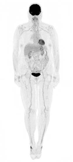 FDG PET scan covering top of head to bottom of feet