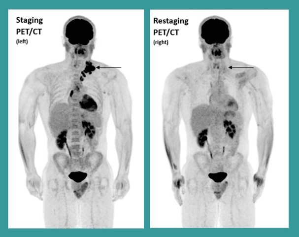FDG Hodgkins Lymphoma