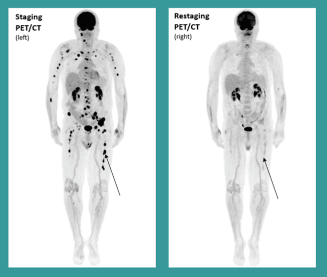 Multiple Myeloma