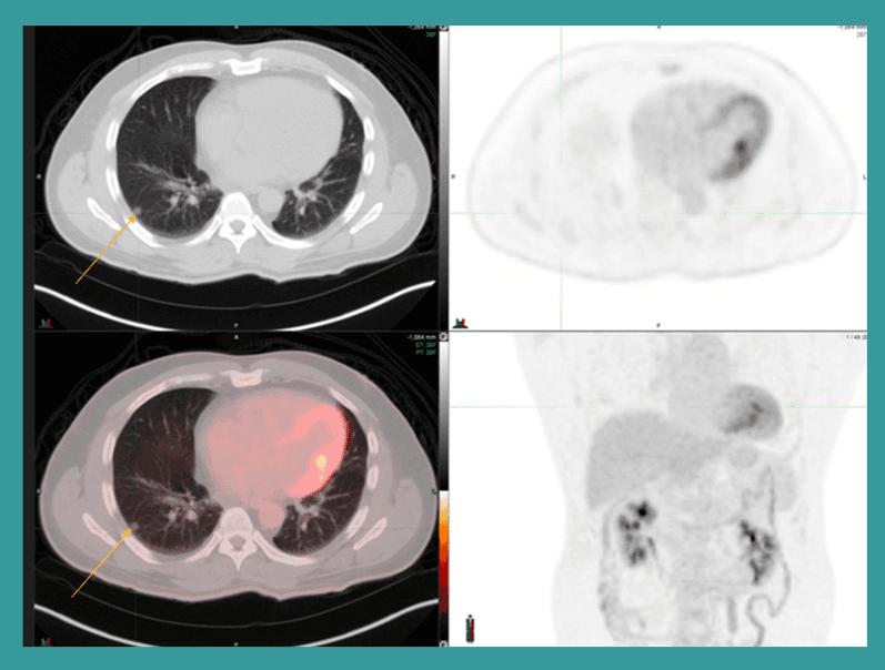 Solitary Pulmonary Nodules