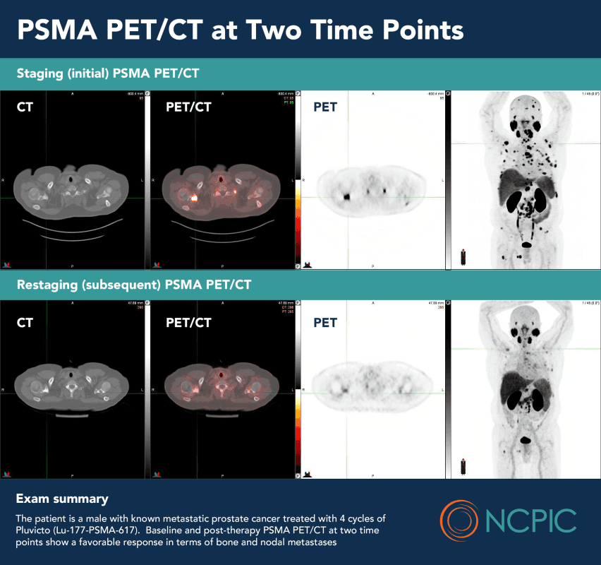 Prostate Specific Membrane Antigen (PSMA)